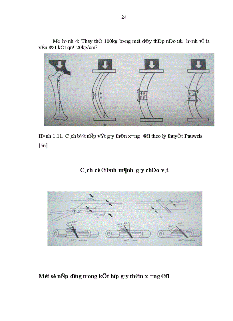 image for page Đánh giá kết quả điều trị gãy kín thân xương đùi ở người lớn bằng nẹp vít tại bệnh viện Việt Đức trong 2 năm 2004 2005 1