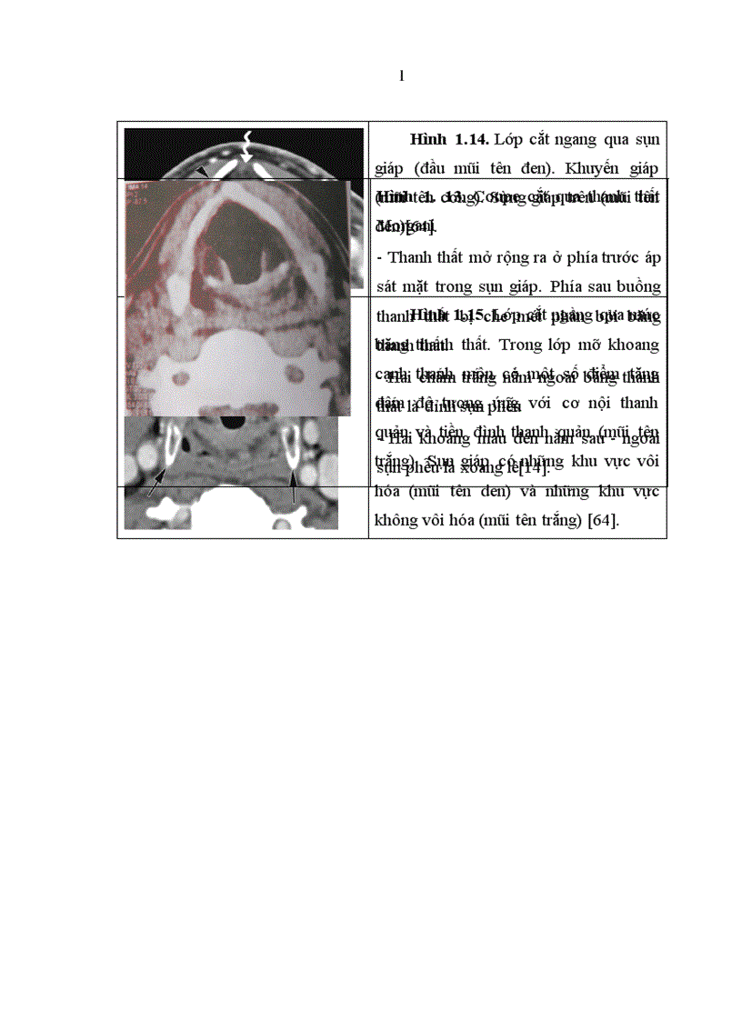 image for page Nghiên cứu đặc điểm lâm sàng và cắt lớp vi tính của ung thư thanh quản giai đoạn T3 T4