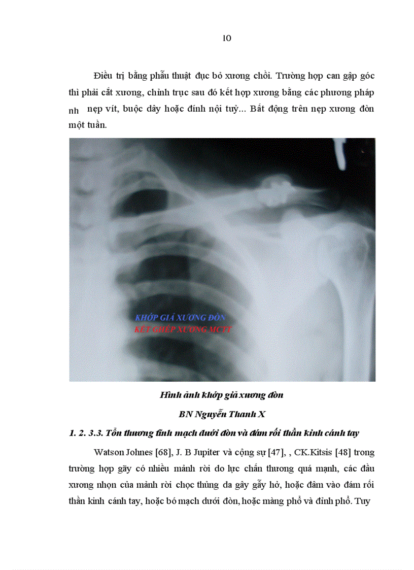 image for page Đánh giá kết quả điều trị khớp giả xương đòn bằng kết xương nẹp vít tại BVTW QĐ 108