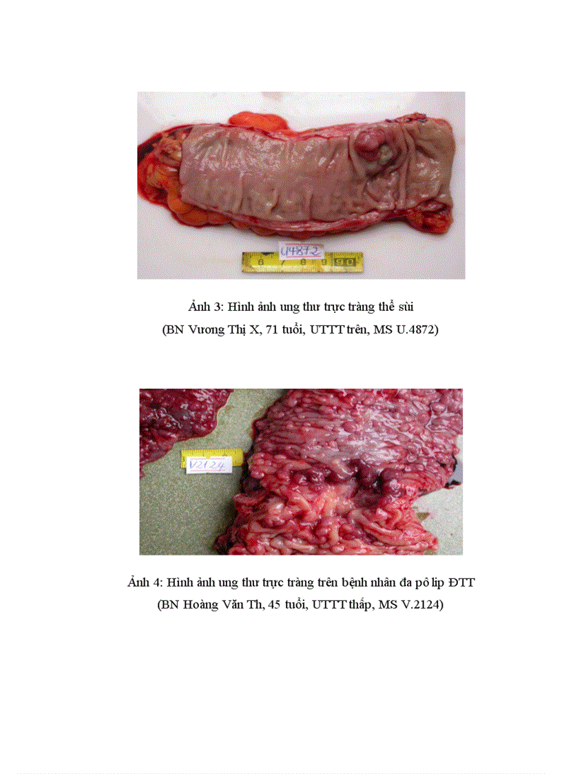 image for page Nghiên cứu mối liên quan giữa khối u với mức độ xâm lấn vào mạc treo của ung thư trực tràng