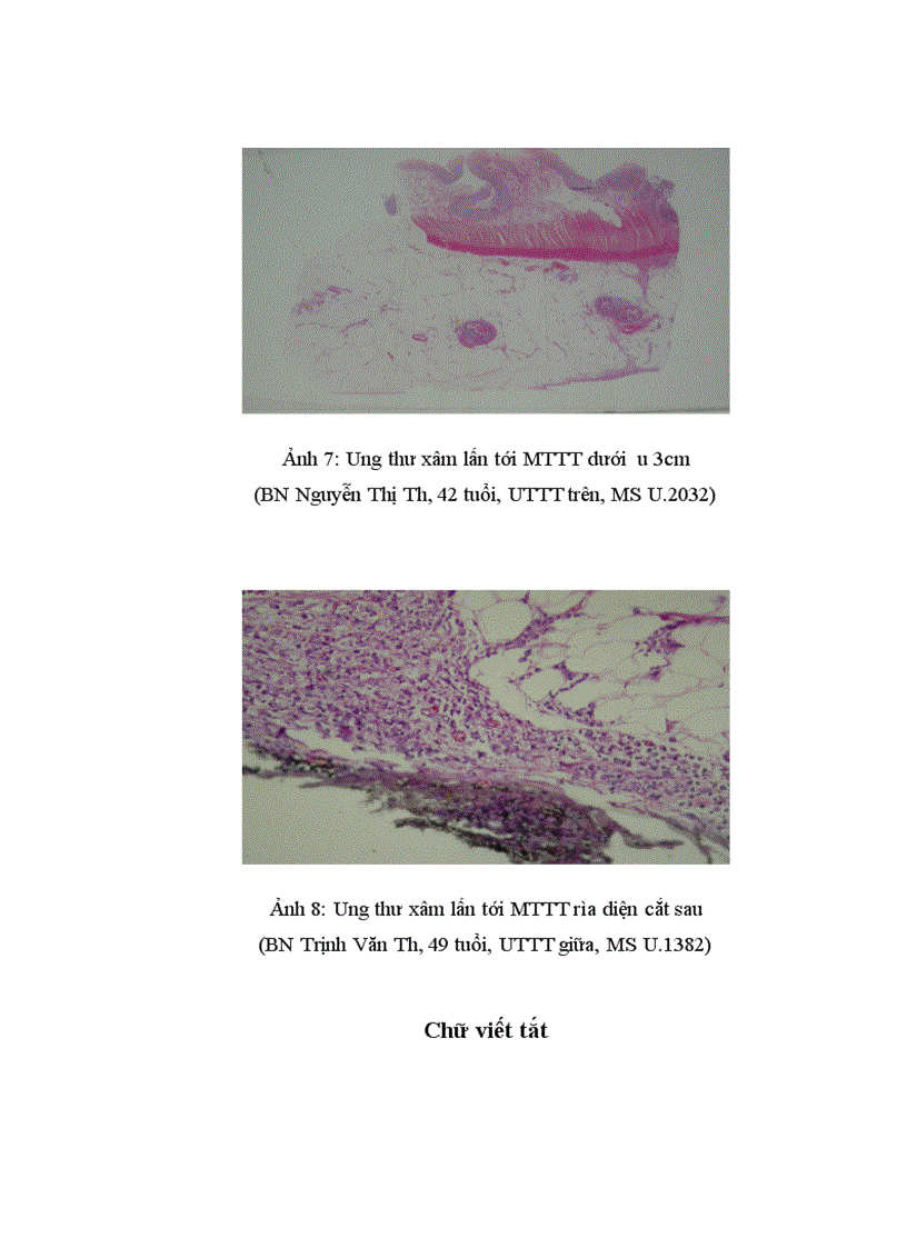 image for page Nghiên cứu mối liên quan giữa khối u với mức độ xâm lấn vào mạc treo của ung thư trực tràng