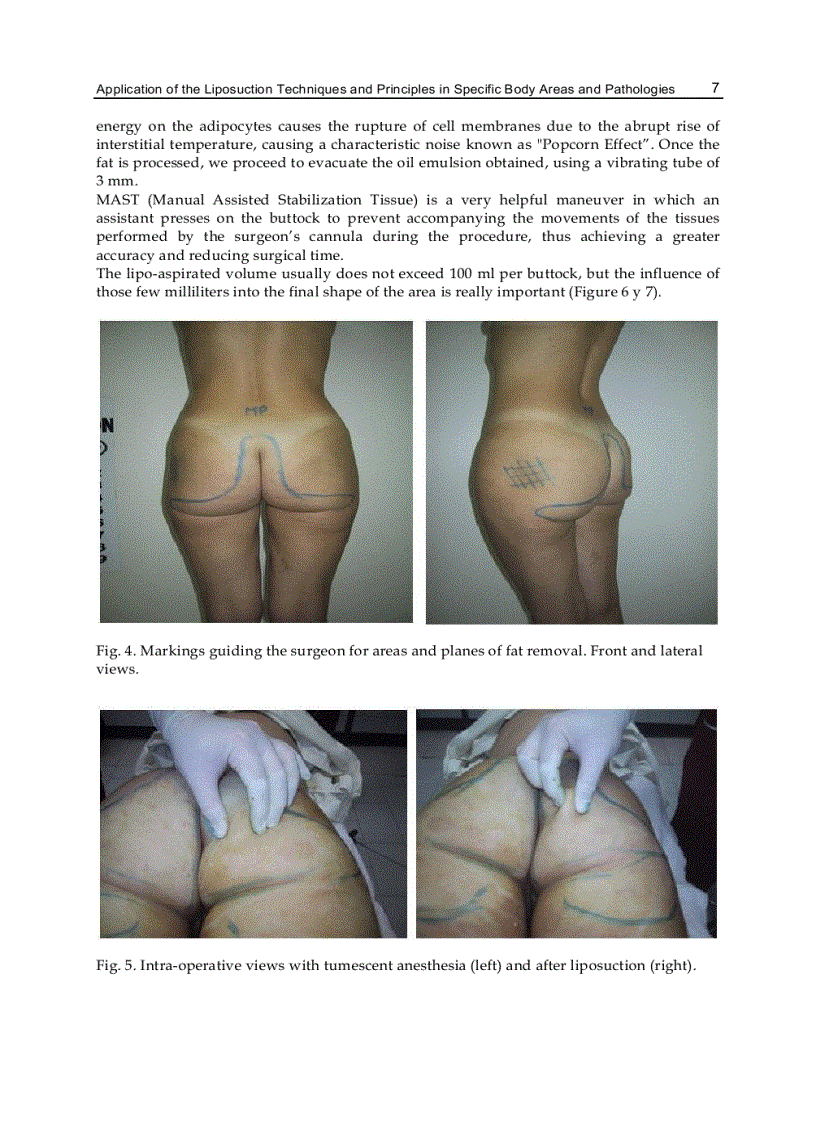 image for page Advanced Techniques in Liposuction and Fat Transfer