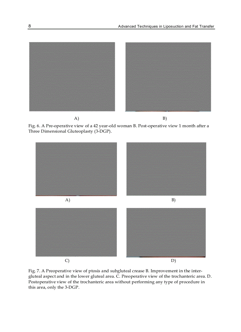 image for page Advanced Techniques in Liposuction and Fat Transfer