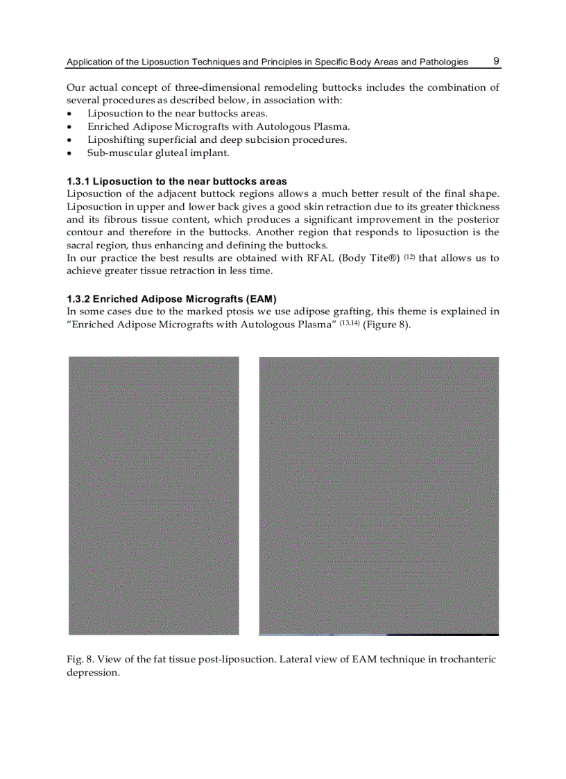 image for page Advanced Techniques in Liposuction and Fat Transfer