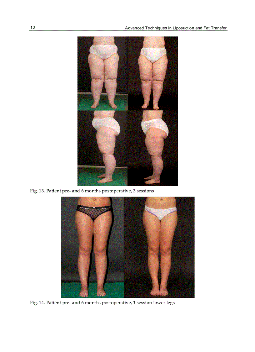 image for page Advanced Techniques in Liposuction and Fat Transfer
