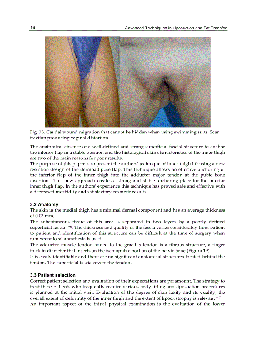 image for page Advanced Techniques in Liposuction and Fat Transfer