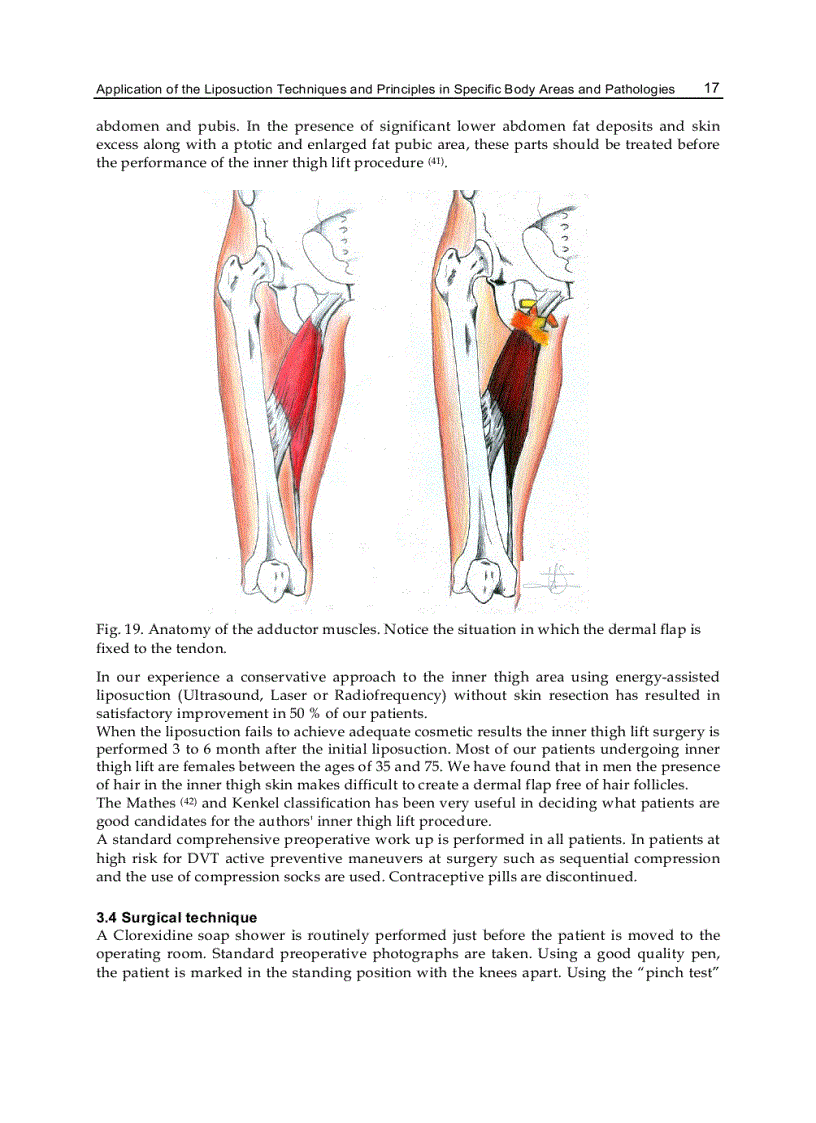 image for page Advanced Techniques in Liposuction and Fat Transfer