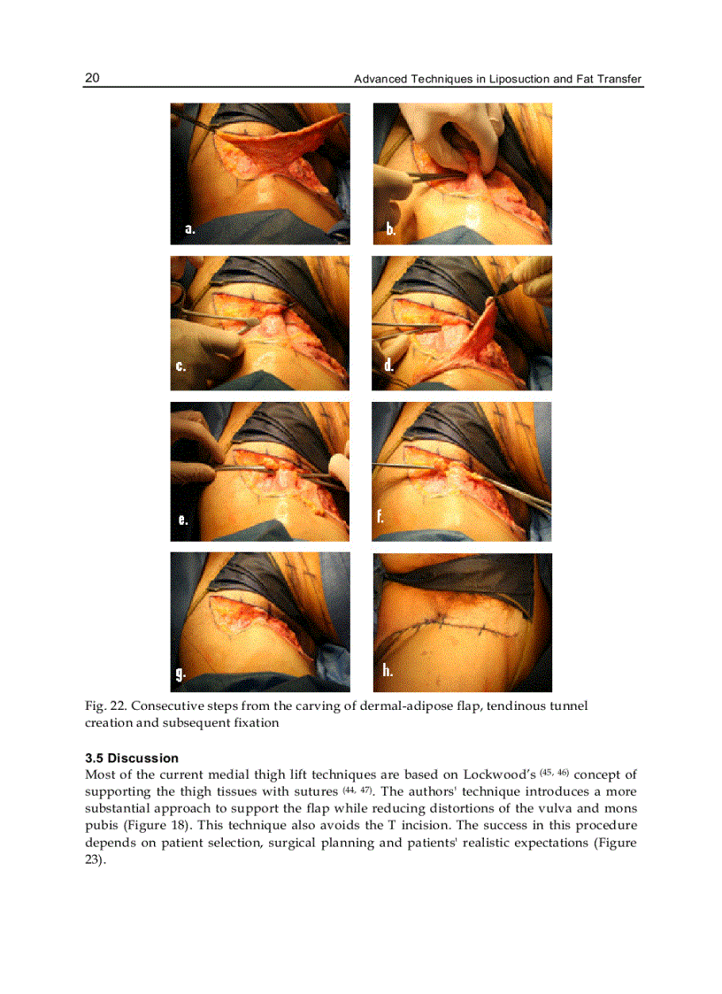image for page Advanced Techniques in Liposuction and Fat Transfer