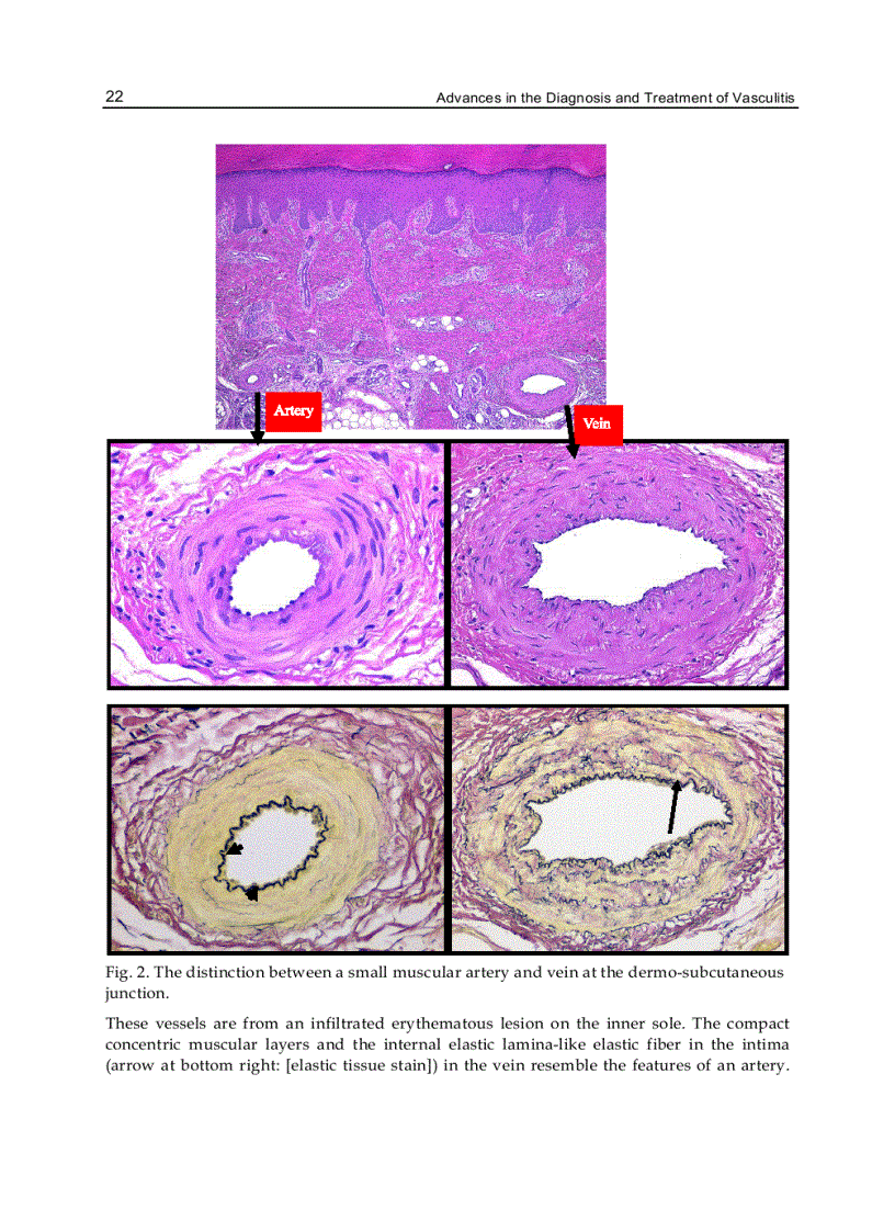 image for page Advances in the Diagnosis and Treatment of Vasculitis
