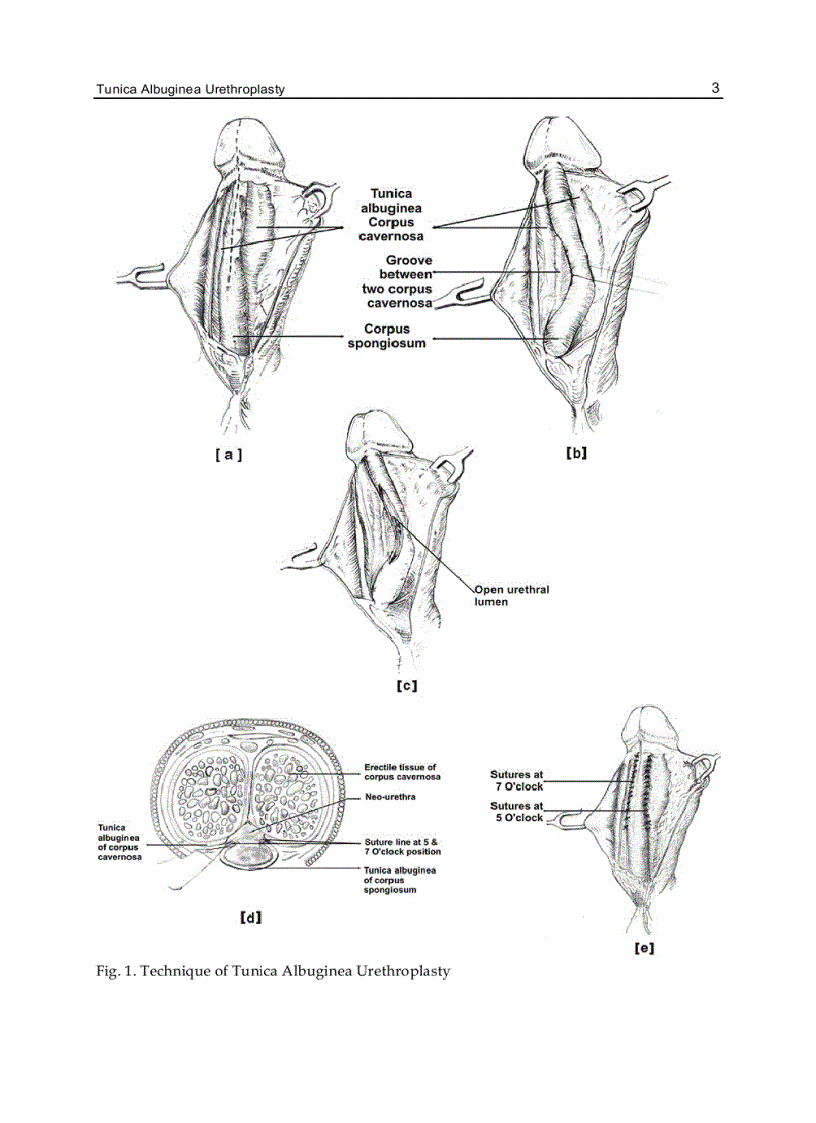 image for page Current Concepts of Urethroplasty