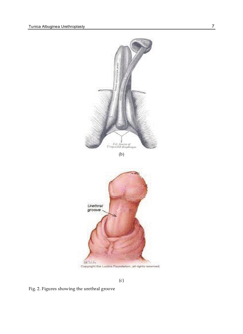 image for page Current Concepts of Urethroplasty