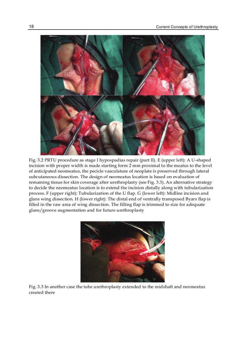 image for page Current Concepts of Urethroplasty