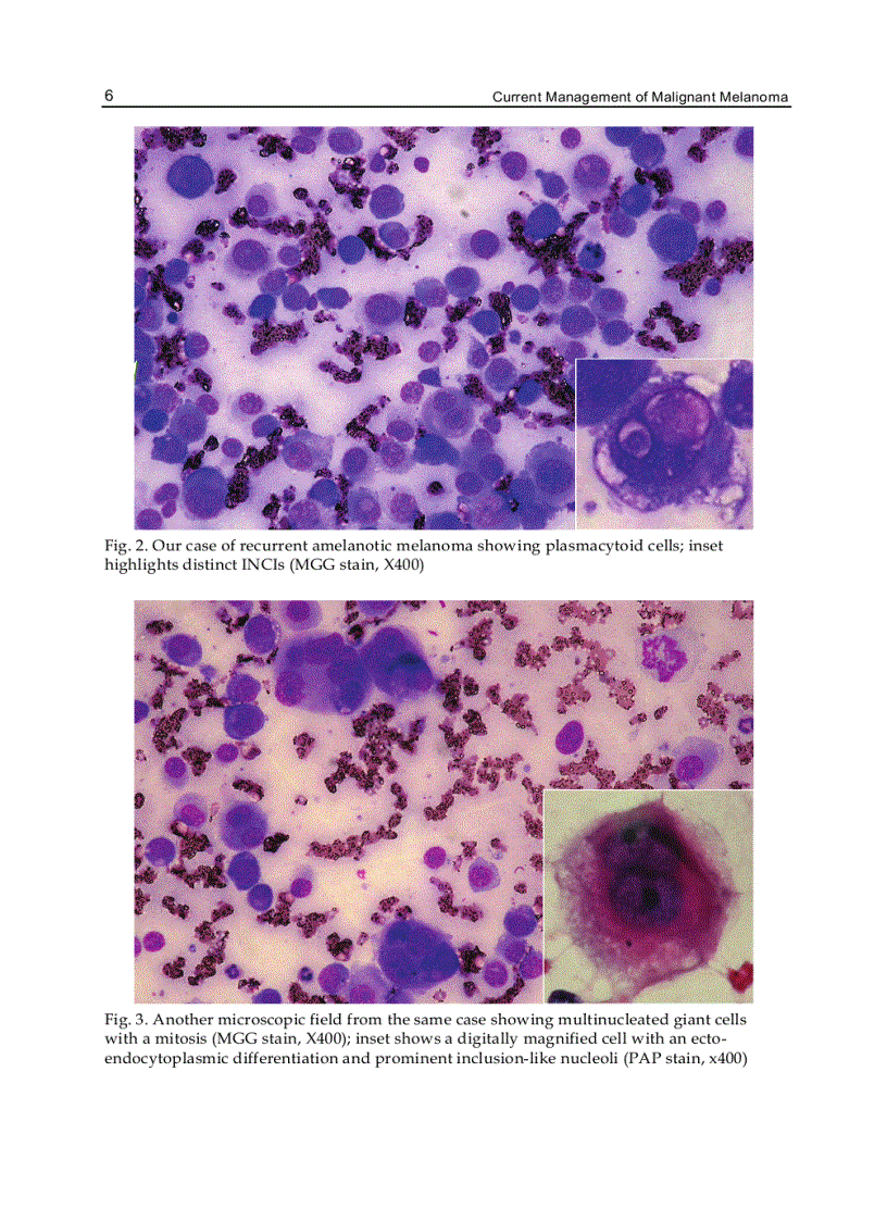 image for page Current Management of Malignant Melanoma