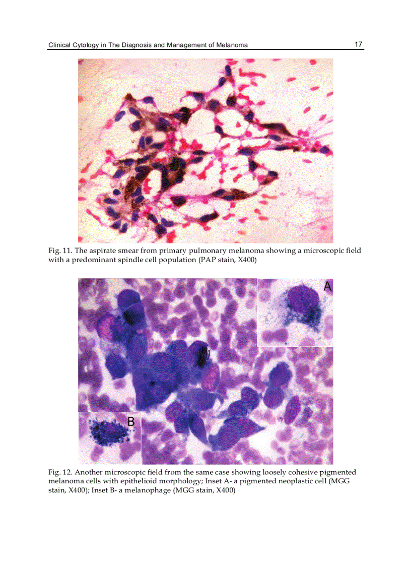 image for page Current Management of Malignant Melanoma