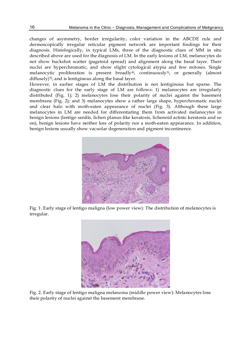 image for page Melanoma in the Clinic Diagnosis Management and Complications of Malignancy