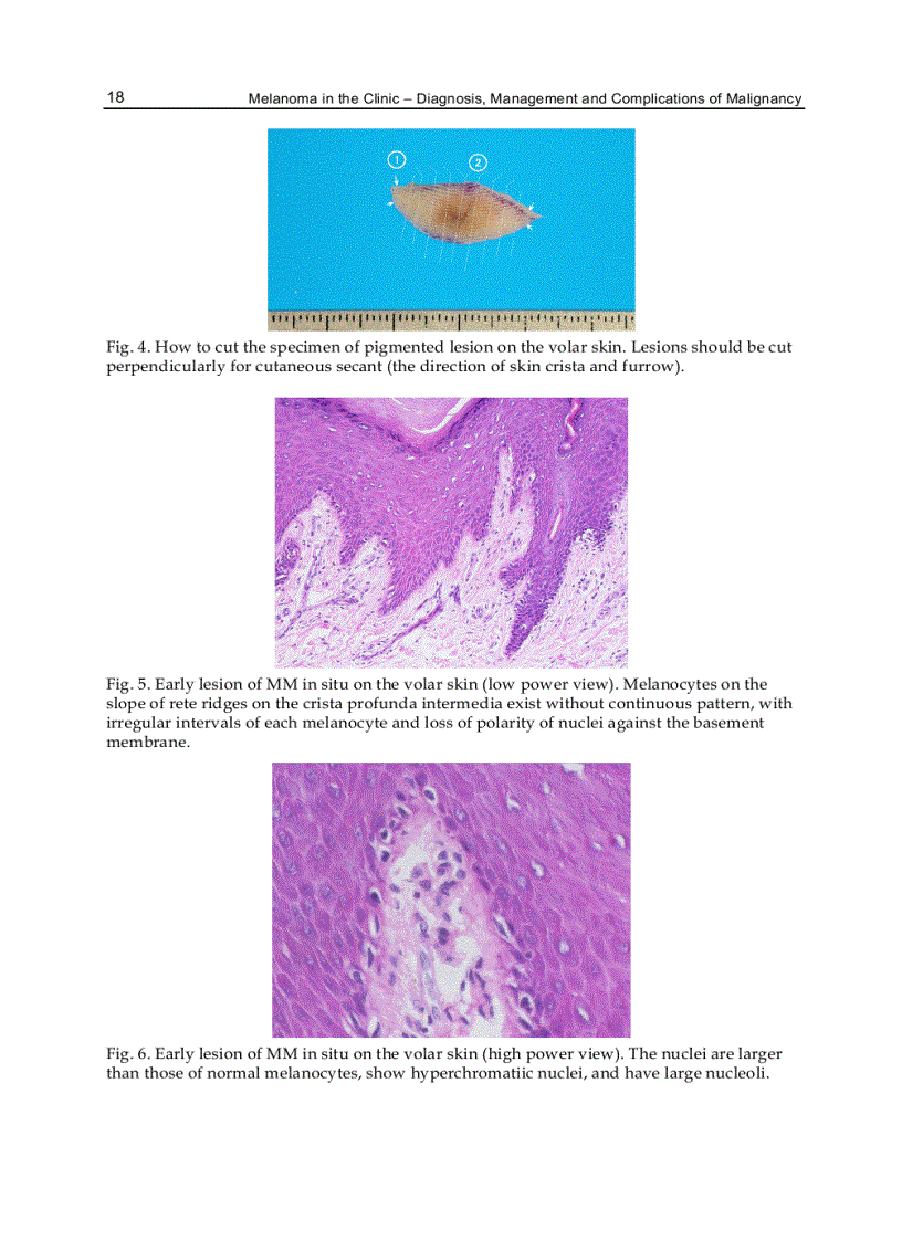 image for page Melanoma in the Clinic Diagnosis Management and Complications of Malignancy