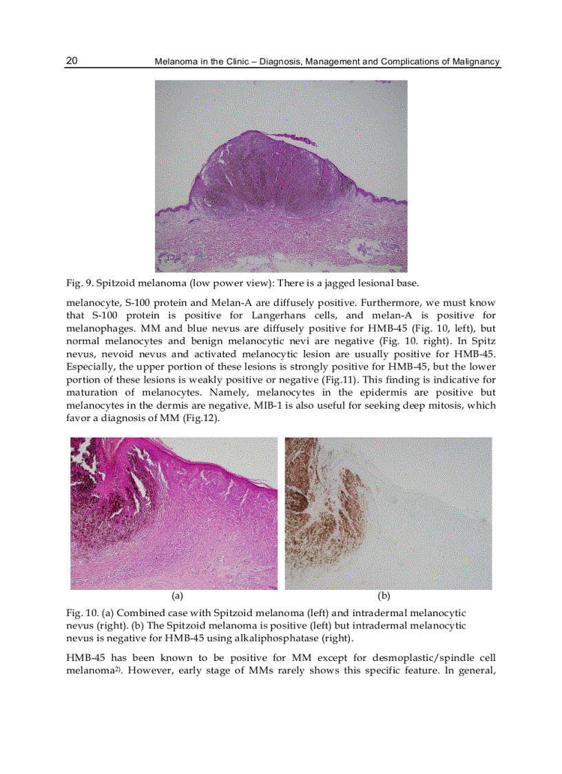 image for page Melanoma in the Clinic Diagnosis Management and Complications of Malignancy