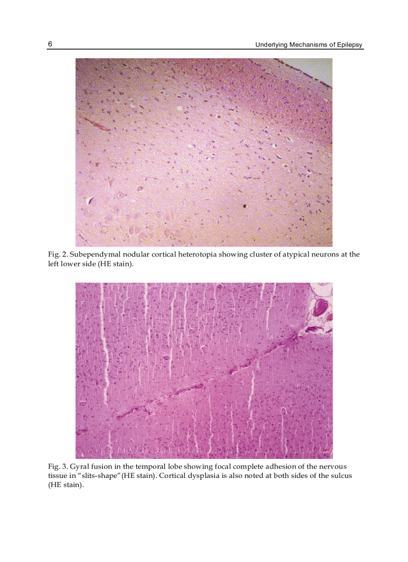 image for page Underlying Mechanisms of Epilepsy
