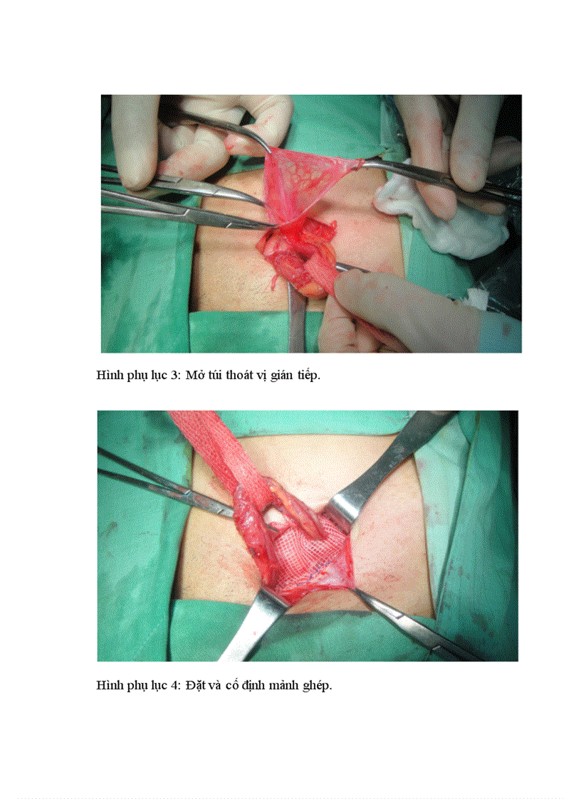 image for page Nghiên cứu đặc điểm lâm sàng cận lâm sàng và kết quả điều trị thoát vị bẹn bằng mổ mở đặt mảnh ghép theo Lichtenstein tại Cần Thơ