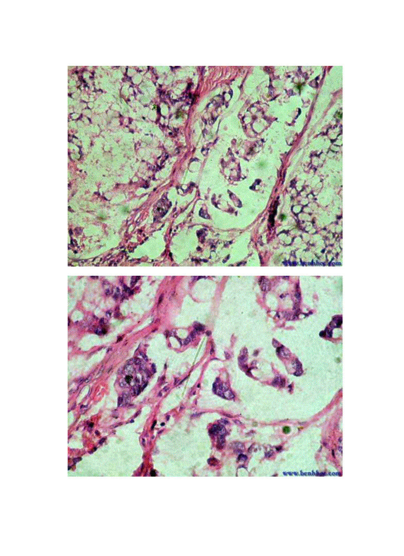 image for page Nghiên cứu triệu chứng lâm sàng cận lâm sàng ở bệnh nhân cắt toàn bộ dạ dày do ung thư tại bệnh viện Việt Đức từ năm 2006 tới 201