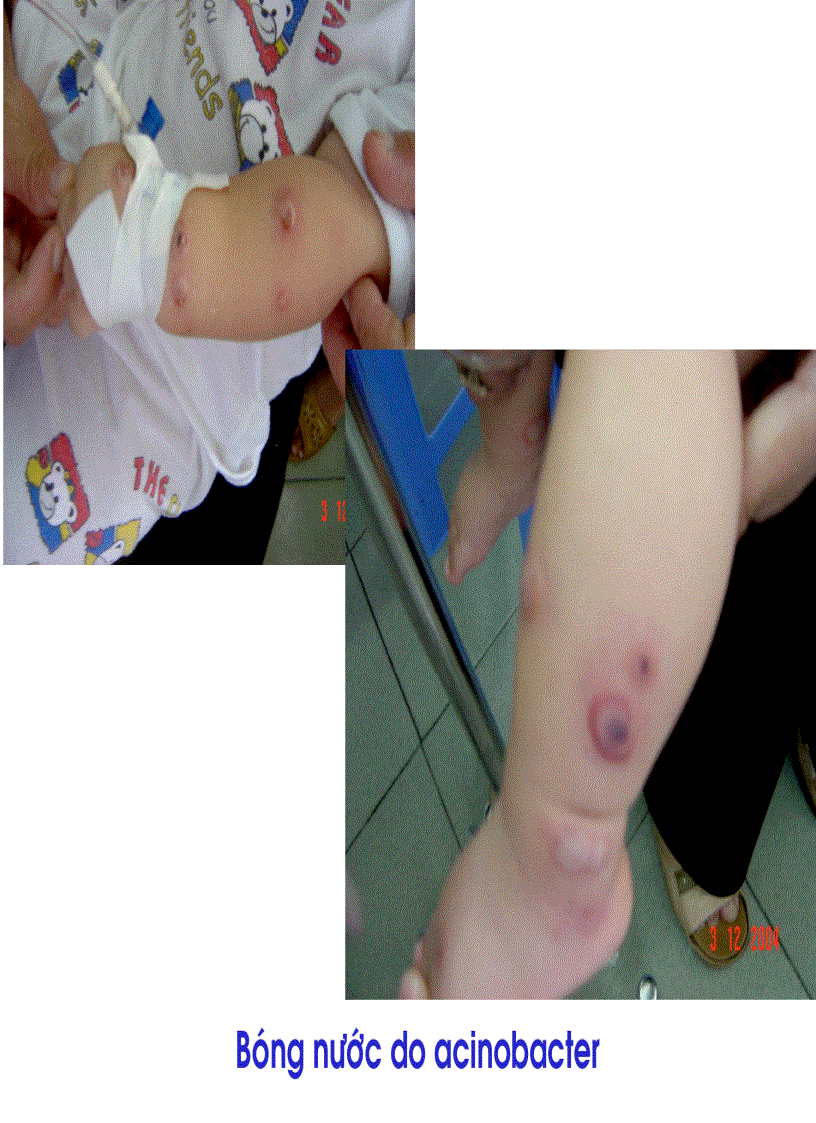 image for page BG Bệnh Tay Chân Miệng