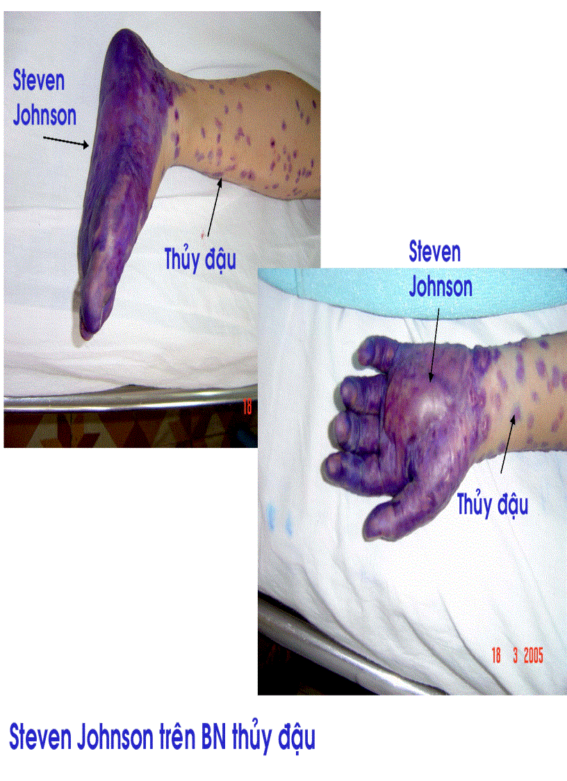 image for page BG Bệnh Tay Chân Miệng