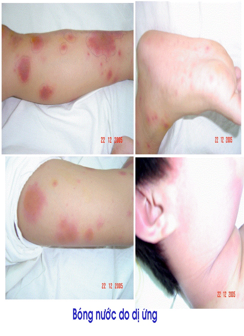 image for page BG Bệnh Tay Chân Miệng