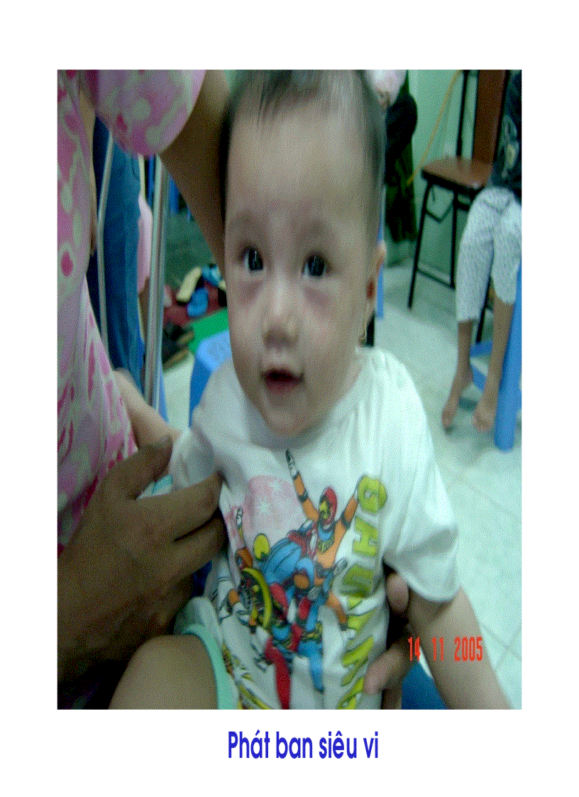 image for page BG Bệnh Tay Chân Miệng