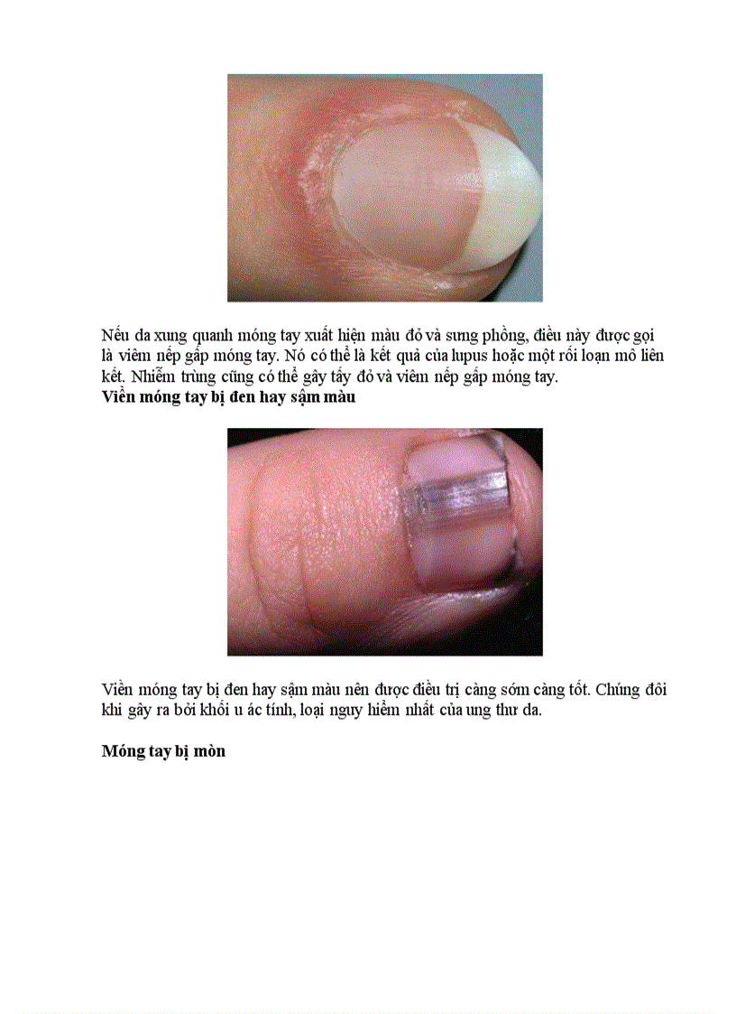image for page Chẩn bệnh qua 9 kiểu móng tay