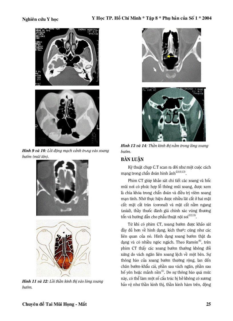 Hình ảnh xoang bướm trên CT Scan