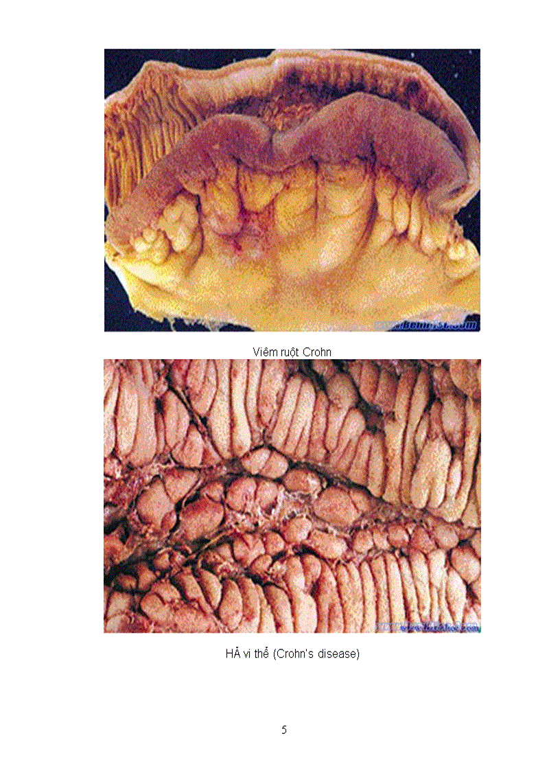 Bệnh ruột non và ruột già Disease of the small and large intestine