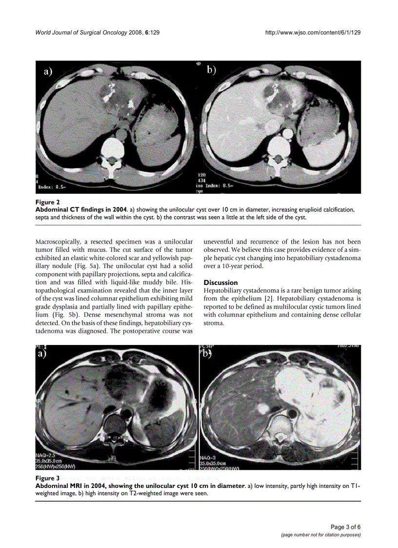 Hepatobiliary cystadenoma exhibiting morphologic changes from simple hepatic cyst shown by 11 year follow up imagings