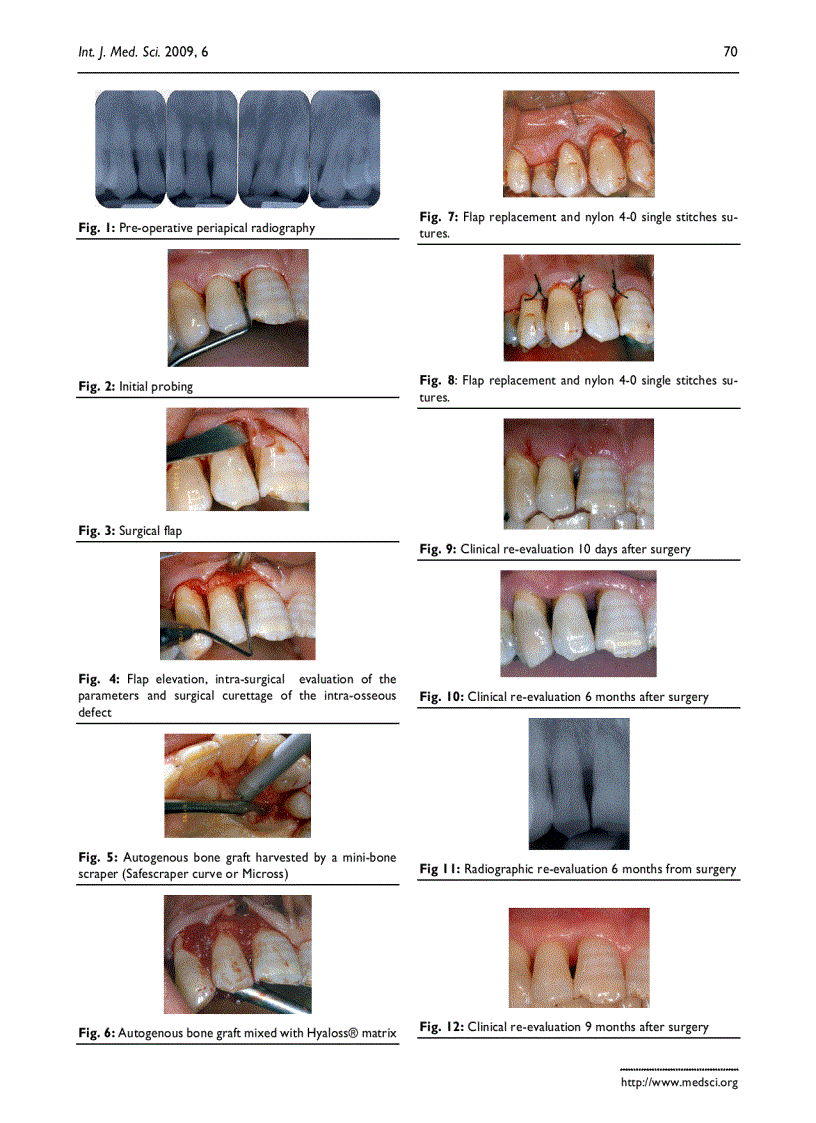 image for page Báo cáo y học Esterified Hyaluronic Acid and Autologous Bone in the Surgical Correction of the Infra Bone Defects