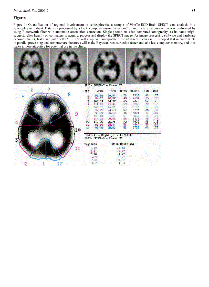 image for page Báo cáo y học Comparison of Classical and Clozapine Treatment on Schizophrenia Using Positive and Negative Syndrome Scale of Schizophrenia PANSS and SPECT Imaging