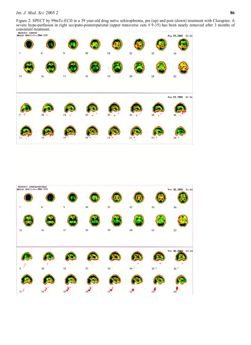 image for page Báo cáo y học Comparison of Classical and Clozapine Treatment on Schizophrenia Using Positive and Negative Syndrome Scale of Schizophrenia PANSS and SPECT Imaging