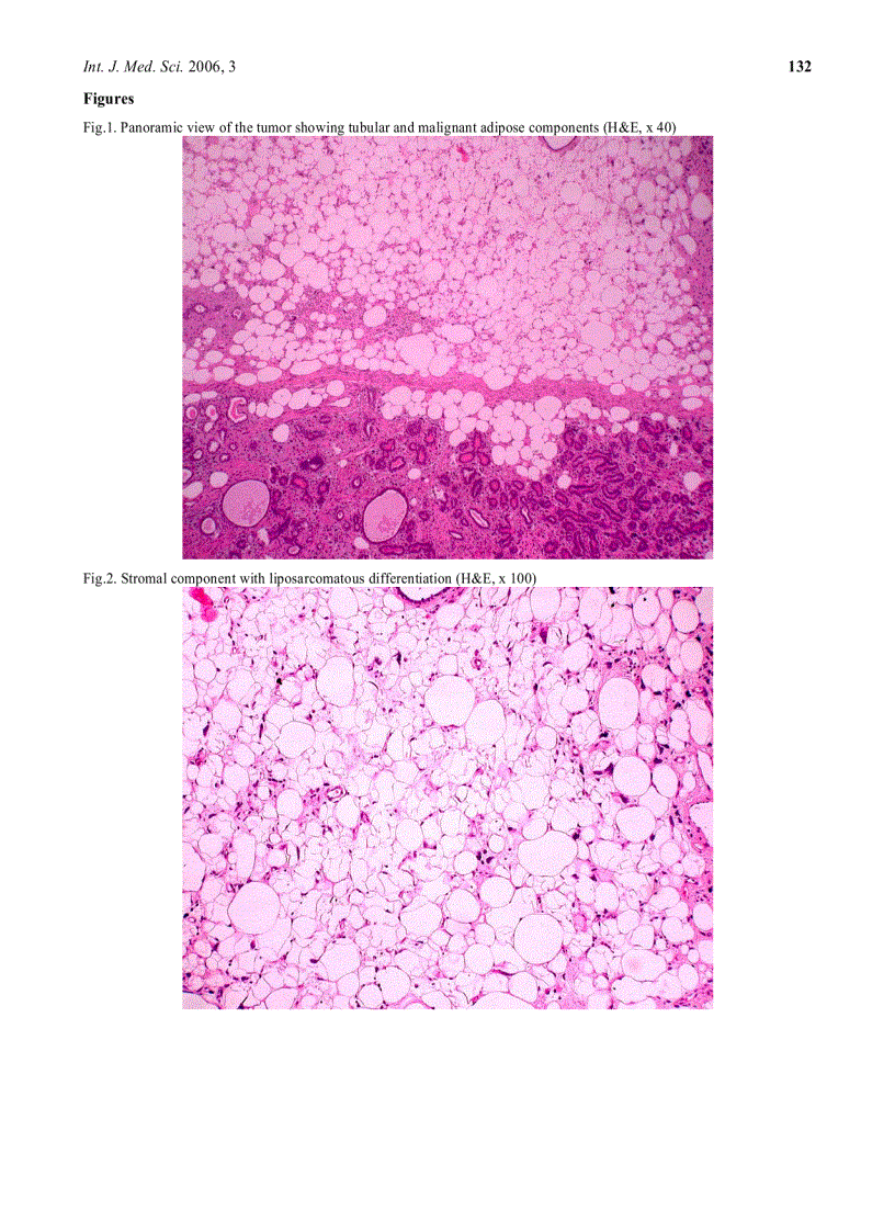 image for page Báo cáo y học Malignant phyllodes tumor with heterologous liposarcomatous differentiation and tubular adenoma like epithelial component