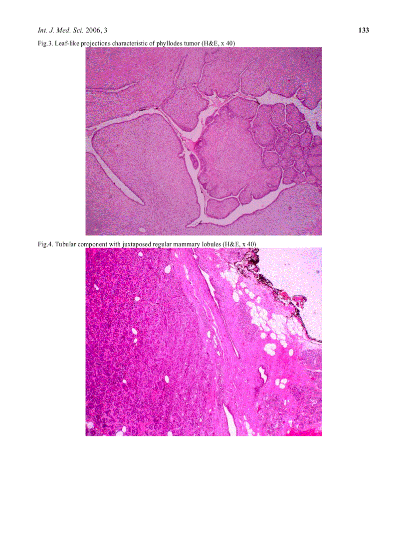 image for page Báo cáo y học Malignant phyllodes tumor with heterologous liposarcomatous differentiation and tubular adenoma like epithelial component