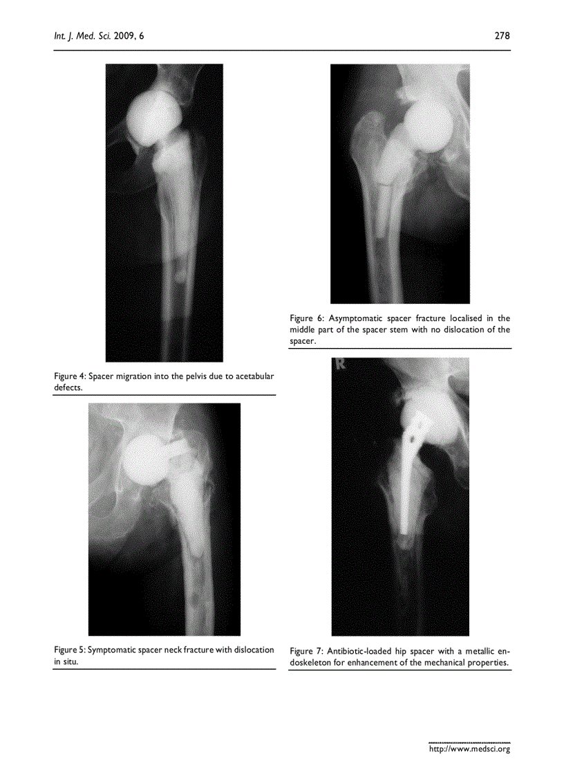 Báo cáo y học Mechanical complications and reconstruction strategies at the site of hip spacer implantation