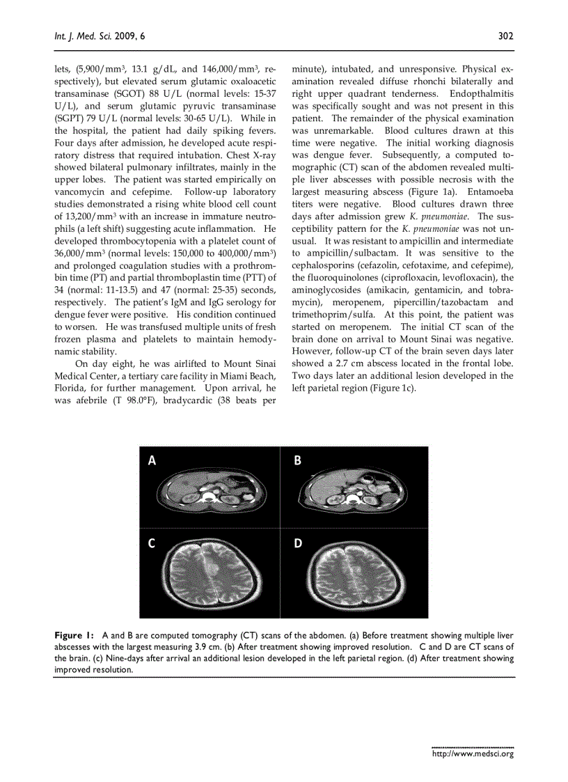 Báo cáo y học A k2A positive Klebsiella pneumoniae causes liver and brain abscess in a Saint Kitt s ma