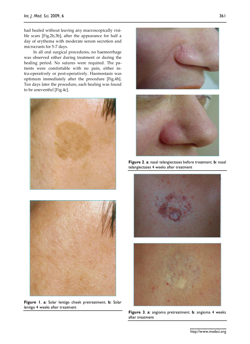 Báo cáo y học 980 nm diode lasers in oral and facial practice current state of the science and art