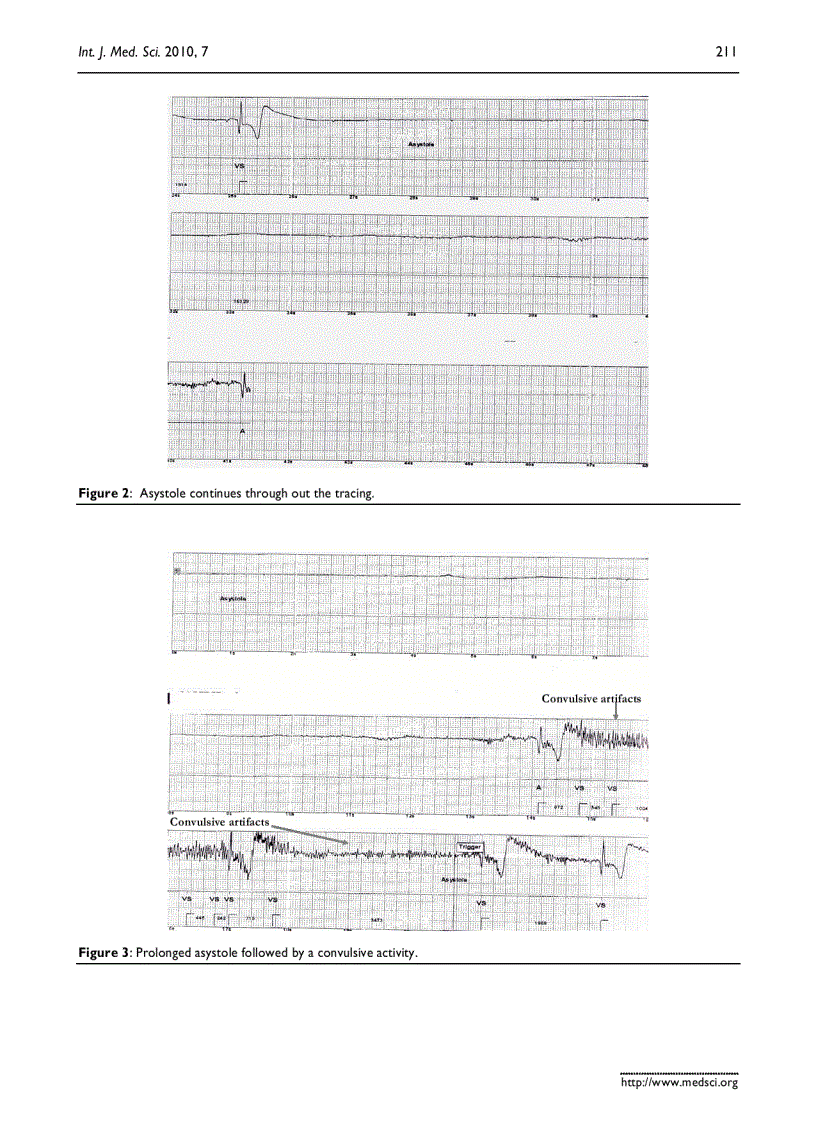 Báo cáo y học A case of mistaken identity Asystole causing convulsions identified using implantable loop recorder