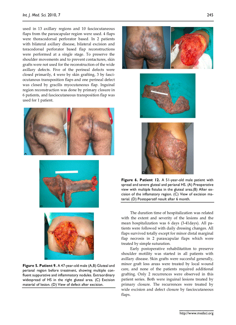 Báo cáo y học surgical Management of Hidradenitis Suppurativa