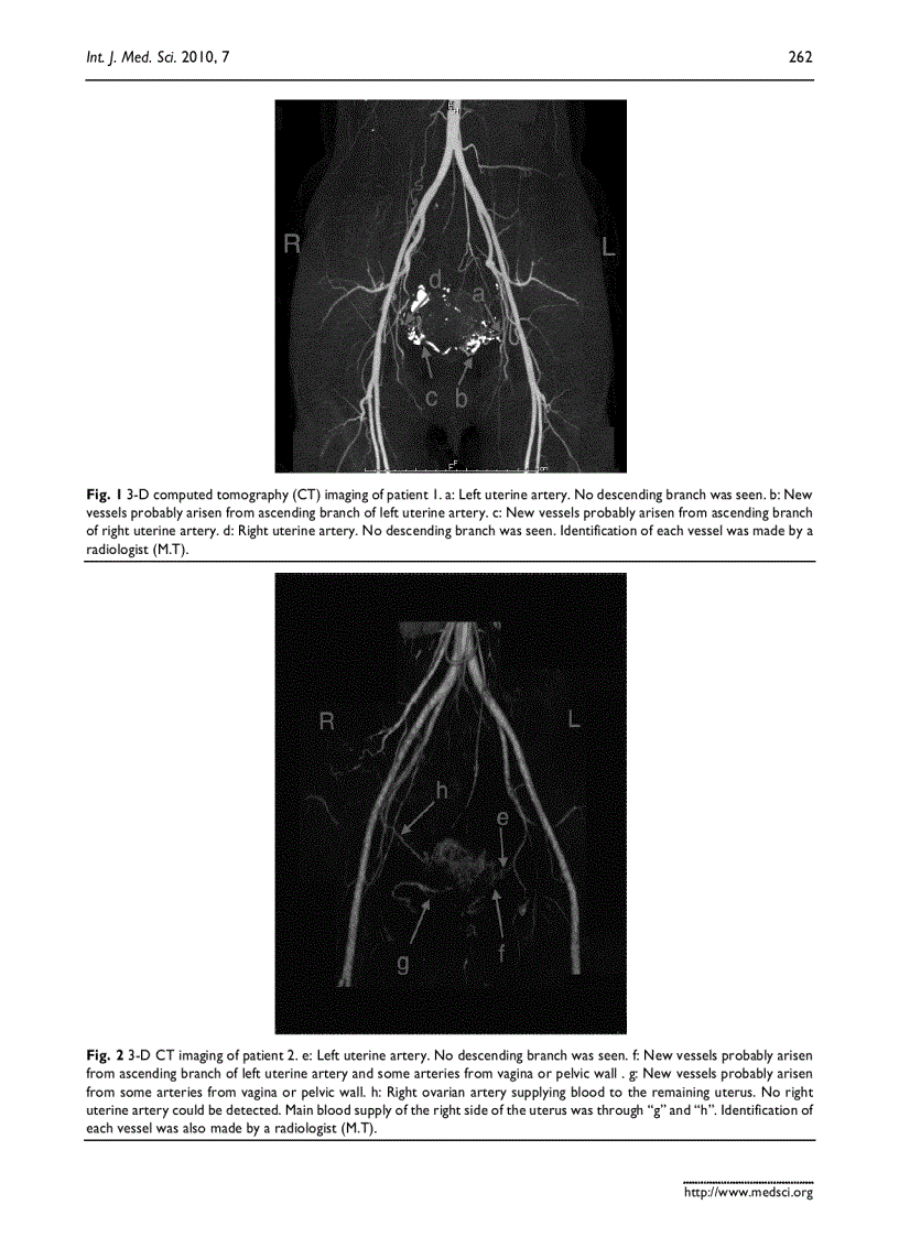 image for page Báo cáo y học Changes of uterine blood flow after vaginal radical trachelectomy VRT in patients with early stage uterine invasive cervical cancer
