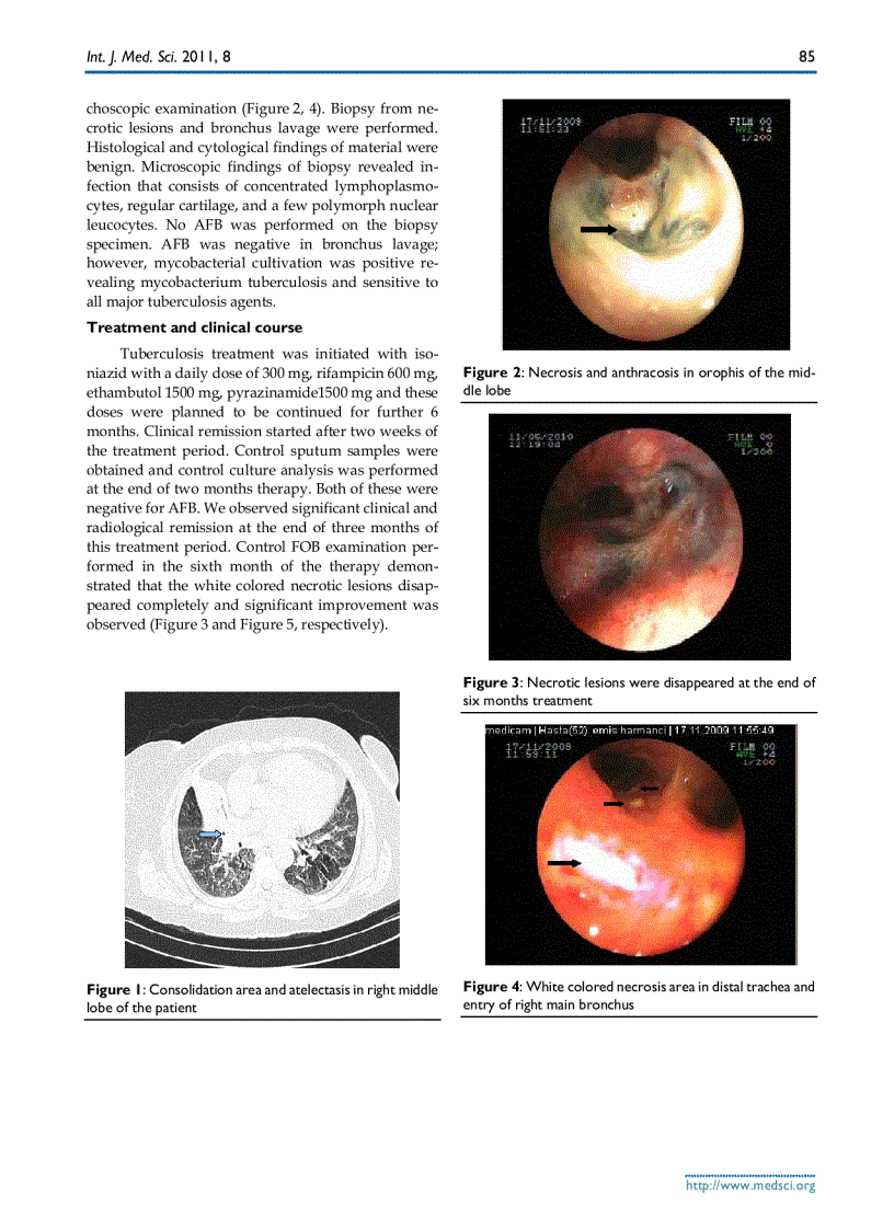 image for page Báo cáo y học Bronchial Anthracofibrosis Case with Endobronchial Tuberculosis