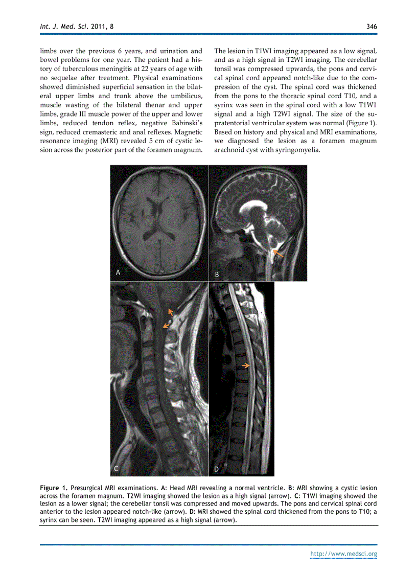 image for page Báo cáo y học Foramen Magnum Arachnoid Cyst Induces Compression of the Spinal Cord and Syringomyelia Case Report and Literature Review