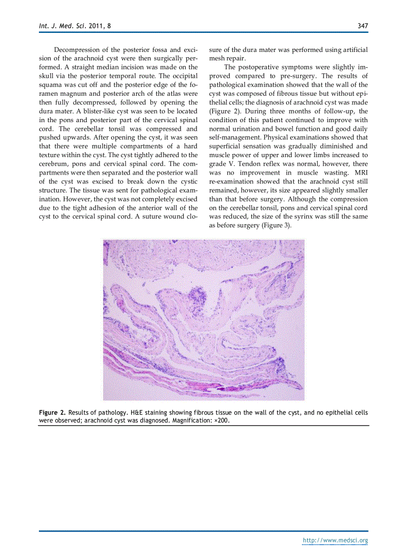 image for page Báo cáo y học Foramen Magnum Arachnoid Cyst Induces Compression of the Spinal Cord and Syringomyelia Case Report and Literature Review