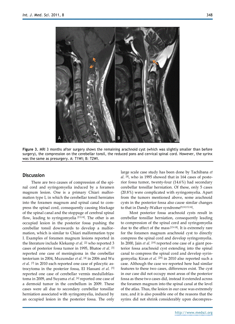 image for page Báo cáo y học Foramen Magnum Arachnoid Cyst Induces Compression of the Spinal Cord and Syringomyelia Case Report and Literature Review