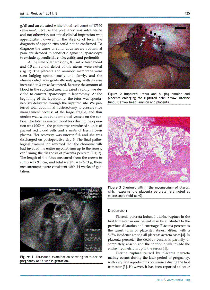 Báo cáo y học Placenta Percreta Induced Uterine Rupture Diagnosed By Laparoscopy in the First Trimester