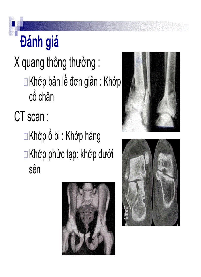 Điều trị gãy xương phạm khớp Hội thảo AO Việt Nam 2009