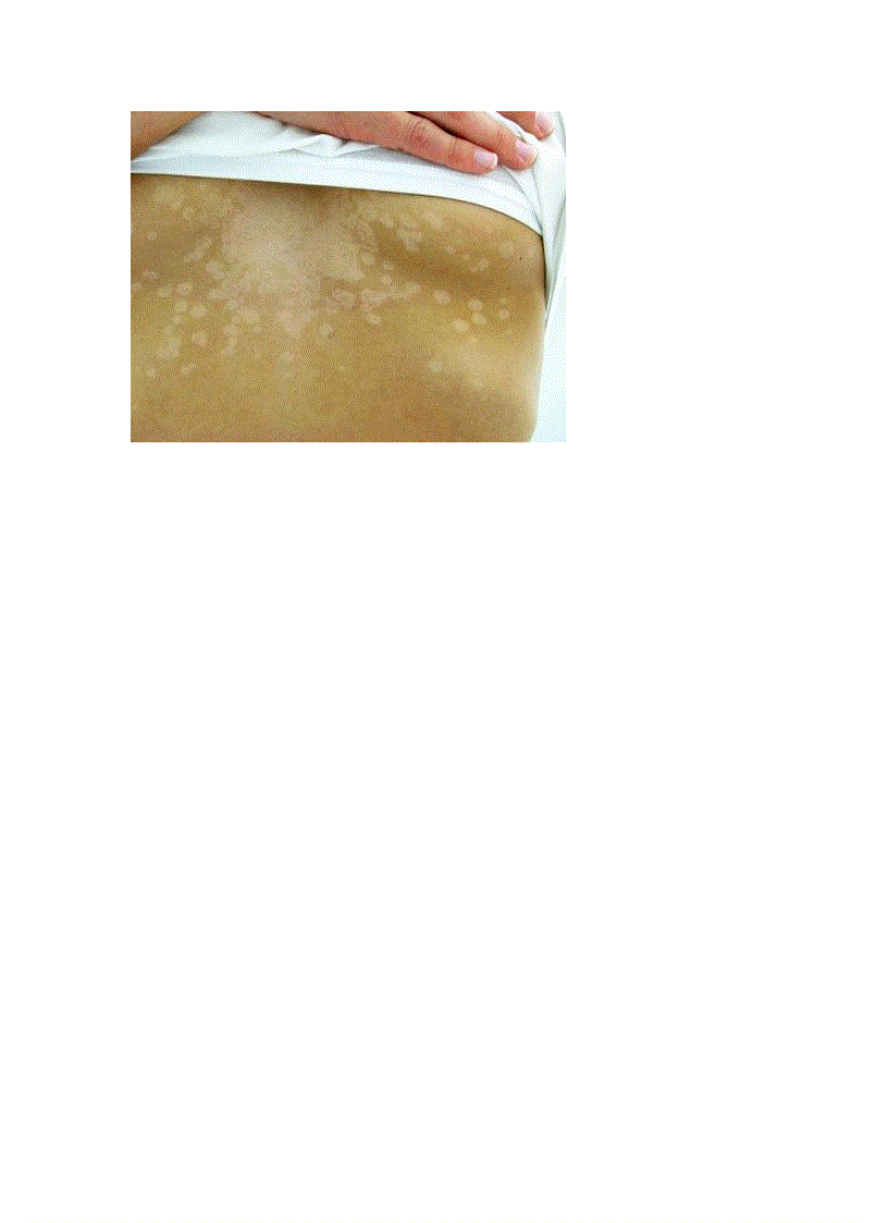 image for page Bệnh lang ben